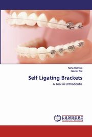 Self Ligating Brackets, Rathore Neha